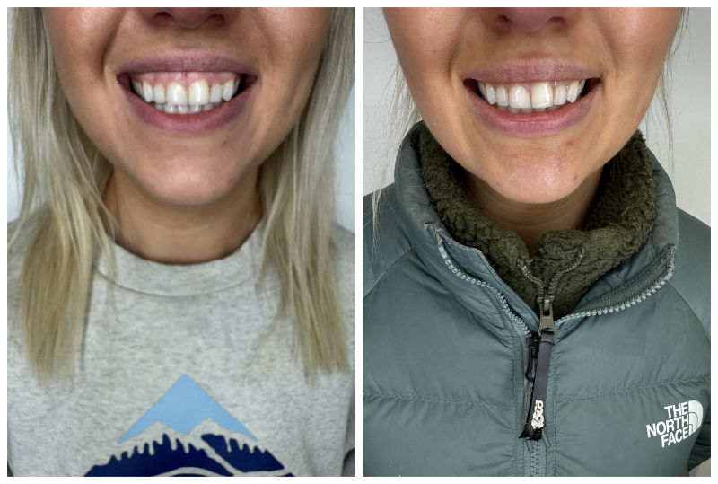 Gummy Smile Before & After