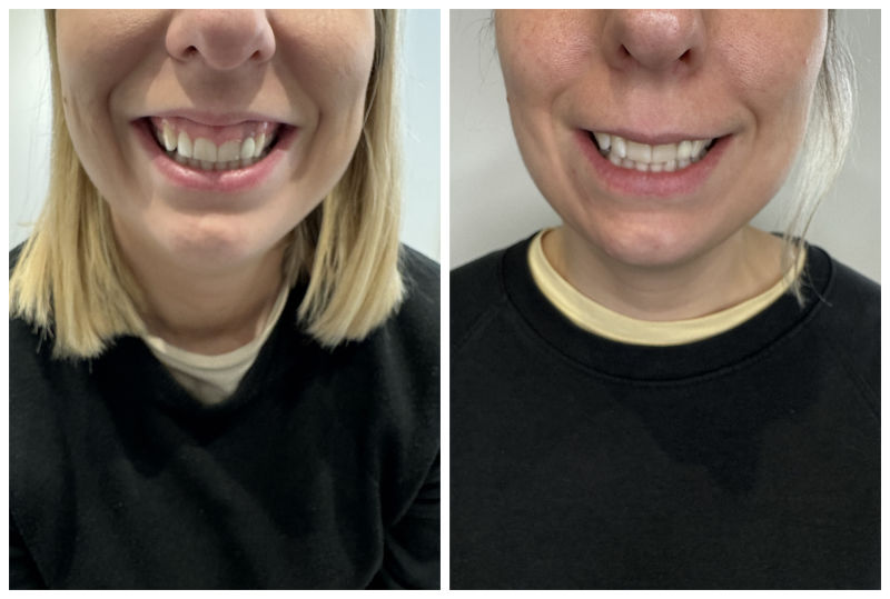 Gummy Smile Before & After