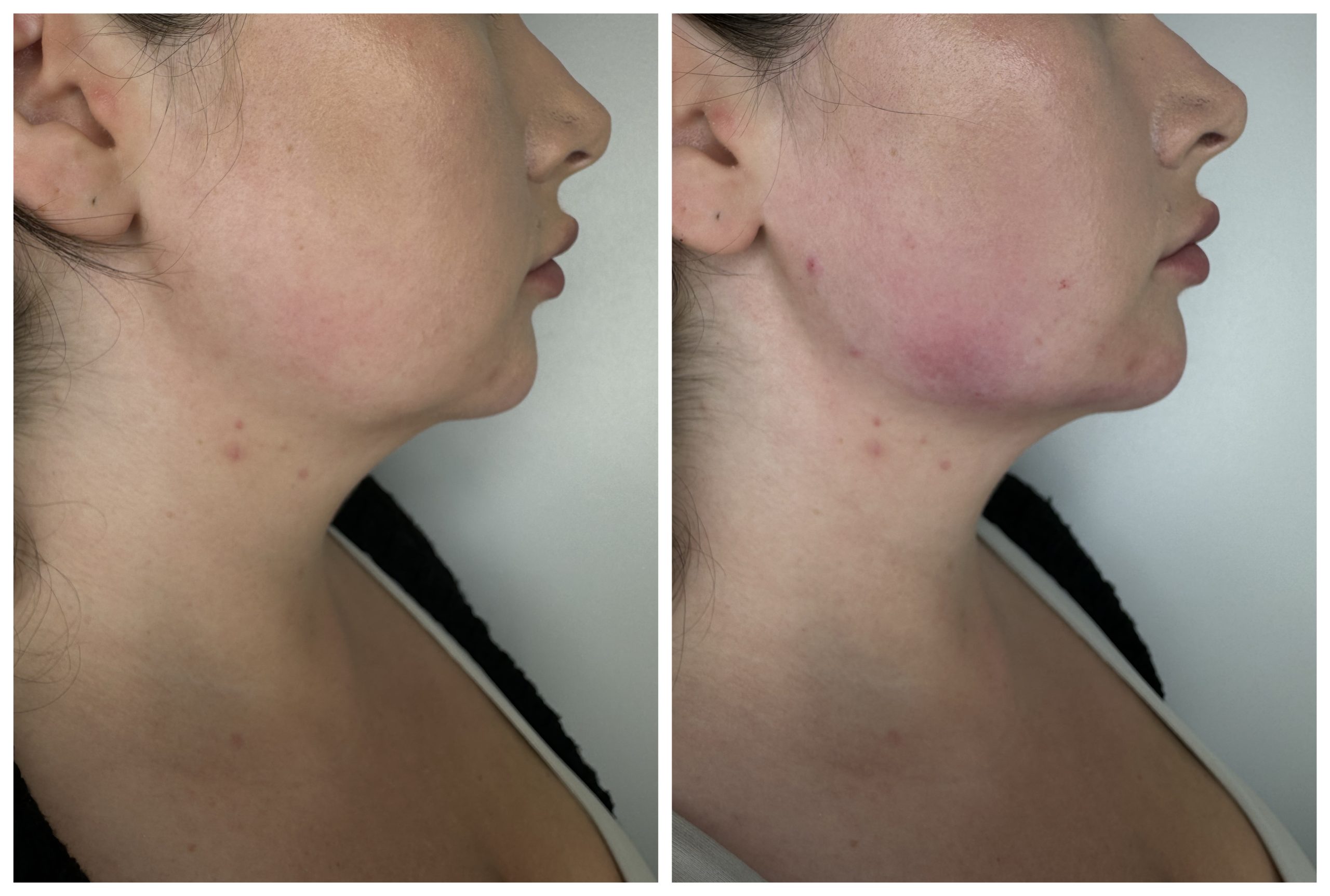 Jawline Enhancement Before and After