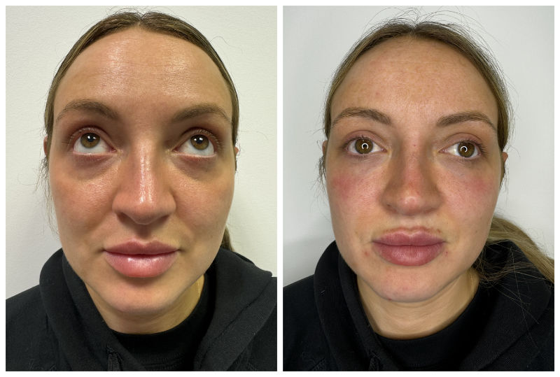 Tear Trough Before & After