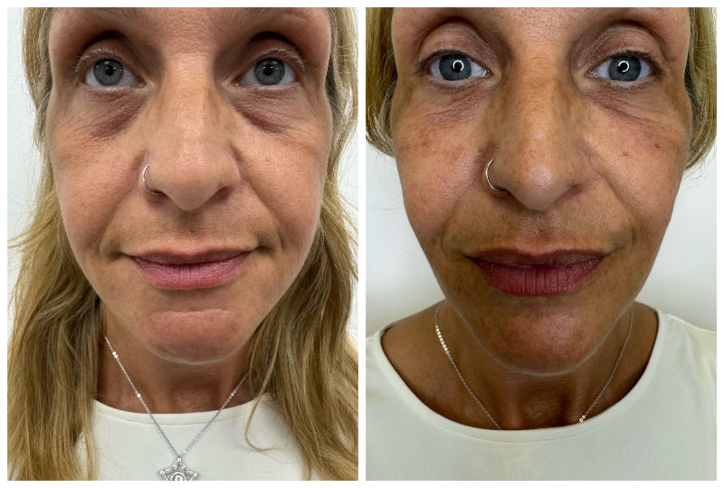 Tear Trough Before & After