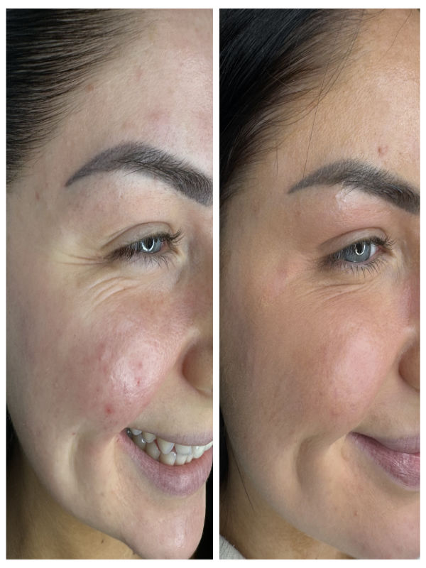 Upper Face Anti-Wrinkle Before and After