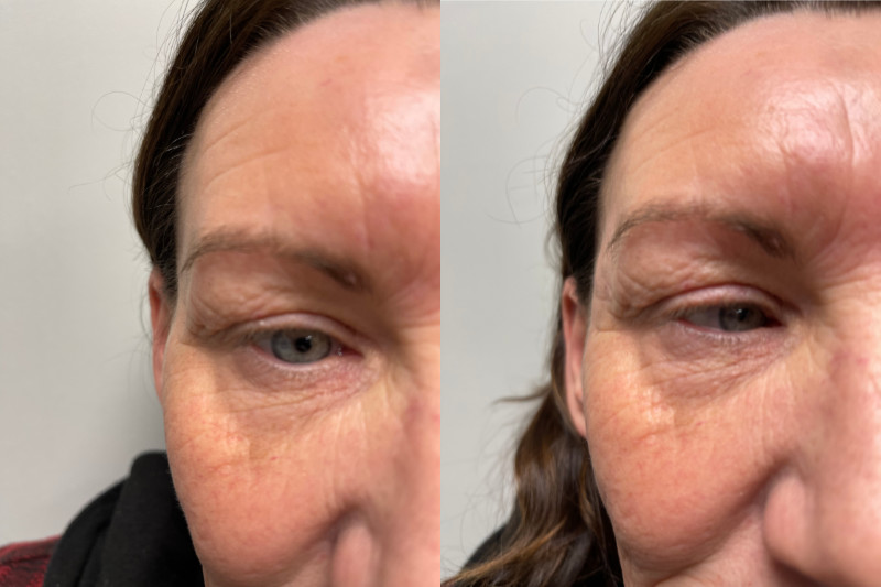 Temple Filler Before and After