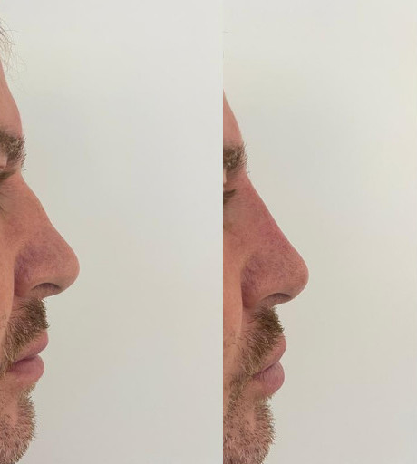 Non-surgical Rhinoplasty Before & After