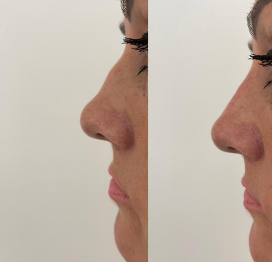 Non-surgical Rhinoplasty Before & After