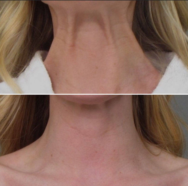 Platysmal Bands Before & After