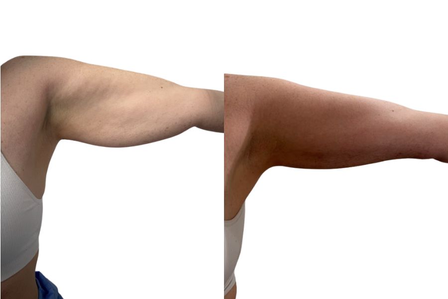Vaser liposuction upper arms before and after