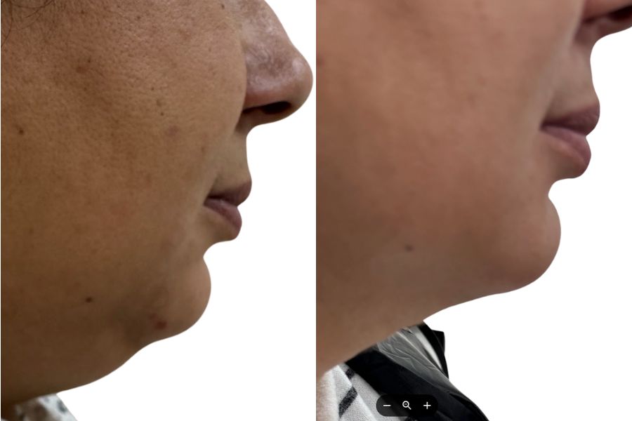 Vaser liposuction double chin before and after