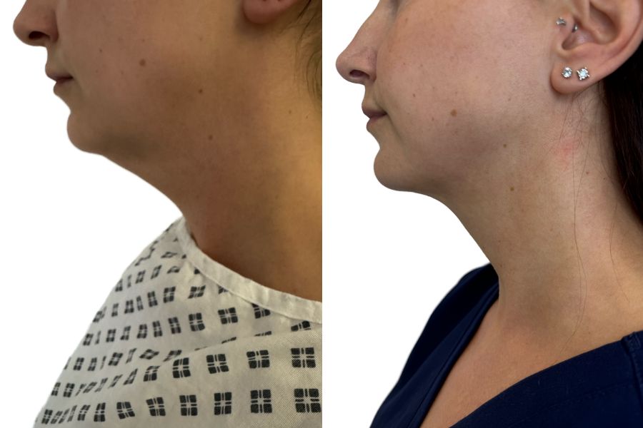 Vaser liposuction jawline and chin before and after