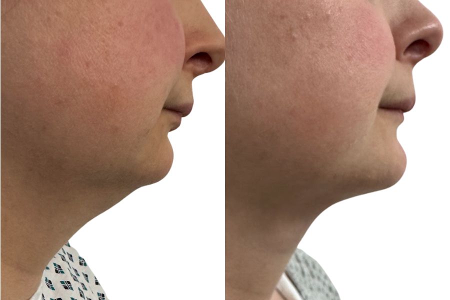 Vaser liposuction chin before and after