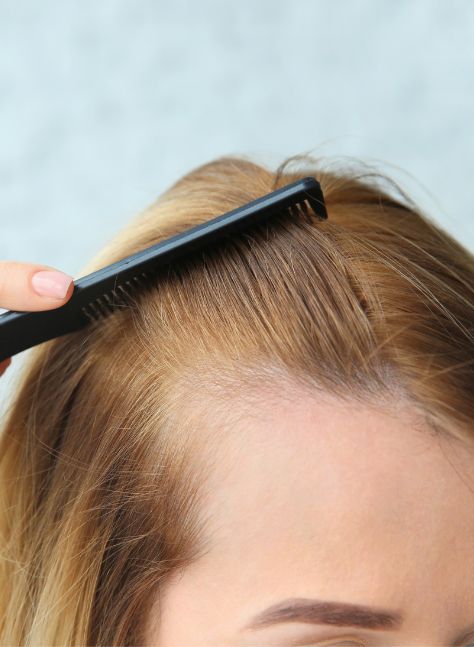 Hair Loss rectangle image