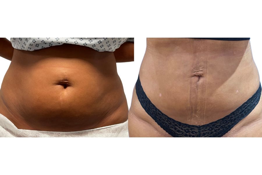 Vaser liposuction abdomen before and after